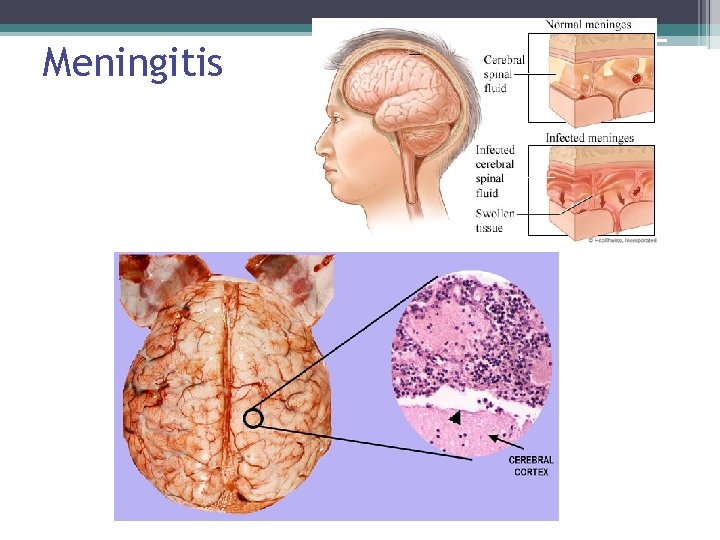 Meningitis 