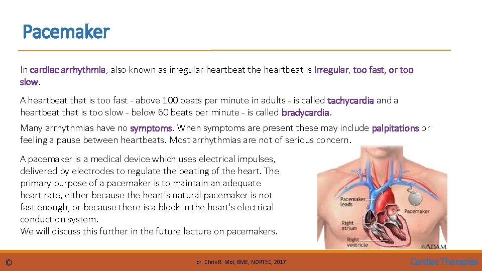 Pacemaker In cardiac arrhythmia, also known as irregular heartbeat the heartbeat is irregular, too