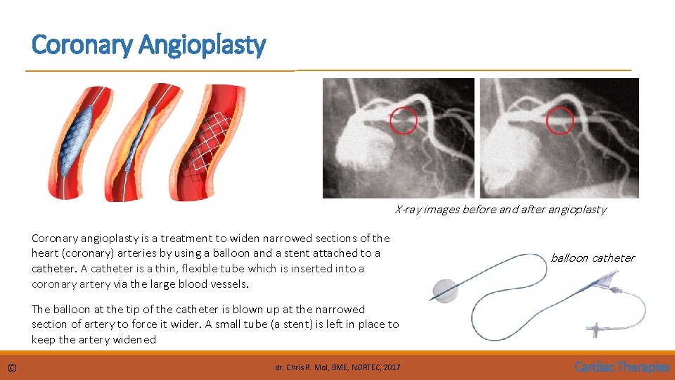 Coronary Angioplasty X-ray images before and after angioplasty Coronary angioplasty is a treatment to