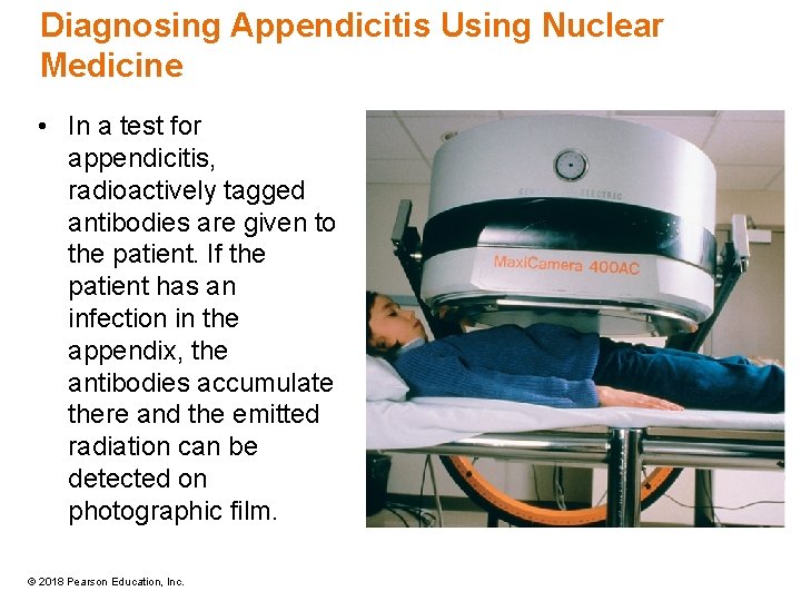 Diagnosing Appendicitis Using Nuclear Medicine • In a test for appendicitis, radioactively tagged antibodies