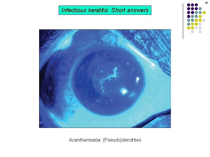 19 Infectious keratitis: Short answers Acanthamoeba: (Pseudo)dendrites 19 Infectious keratitis: Short answers Acanthamoeba: (Pseudo)dendrites