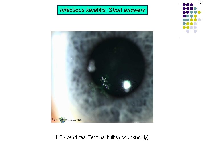 27 Infectious keratitis: Short answers HSV dendrites: Terminal bulbs (look carefully) 27 Infectious keratitis: Short answers HSV dendrites: Terminal bulbs (look carefully)