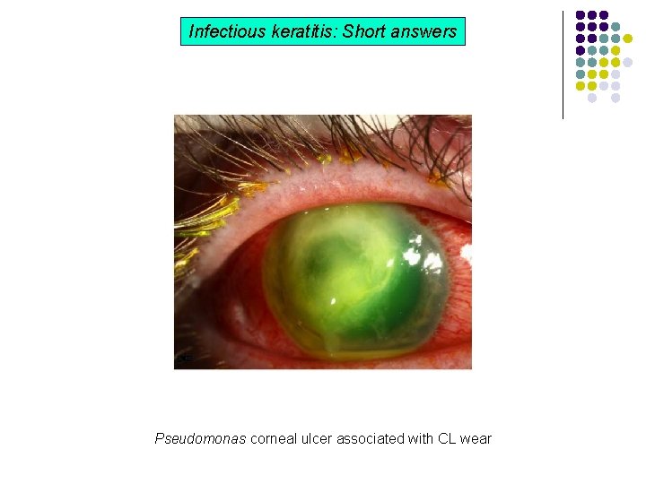 Infectious keratitis: Short answers Pseudomonas corneal ulcer associated with CL wear Infectious keratitis: Short answers Pseudomonas corneal ulcer associated with CL wear