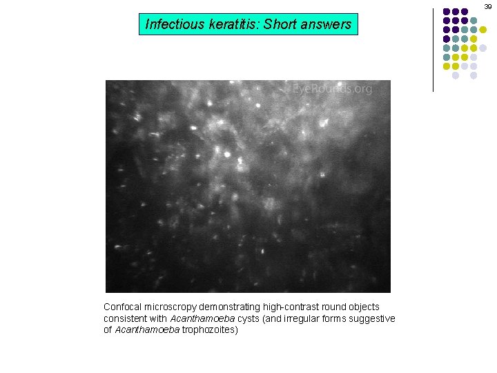 39 Infectious keratitis: Short answers Confocal microscropy demonstrating high-contrast round objects consistent with Acanthamoeba 39 Infectious keratitis: Short answers Confocal microscropy demonstrating high-contrast round objects consistent with Acanthamoeba