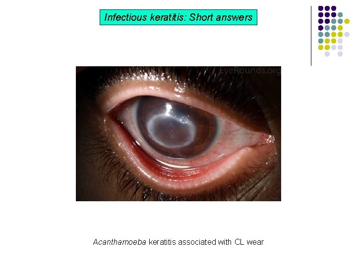 Infectious keratitis: Short answers Acanthamoeba keratitis associated with CL wear Infectious keratitis: Short answers Acanthamoeba keratitis associated with CL wear