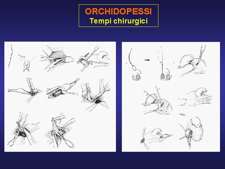 ORCHIDOPESSI Tempi chirurgici 