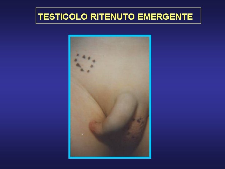 TESTICOLO RITENUTO EMERGENTE 