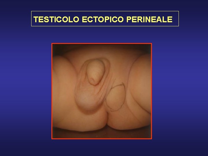 TESTICOLO ECTOPICO PERINEALE 