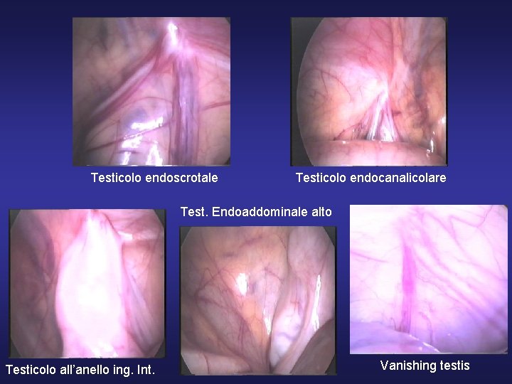 Testicolo endoscrotale Testicolo endocanalicolare Test. Endoaddominale alto Testicolo all’anello ing. Int. Vanishing testis 