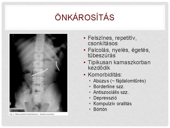 ÖNKÁROSÍTÁS • Felszínes, repetitív, csonkításos • Falcolás, nyelés, égetés, tűbeszúrás • Tipikusan kamaszkorban kezdődik ÖNKÁROSÍTÁS • Felszínes, repetitív, csonkításos • Falcolás, nyelés, égetés, tűbeszúrás • Tipikusan kamaszkorban kezdődik