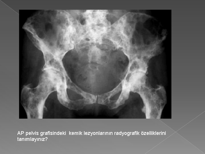 AP pelvis grafisindeki kemik lezyonlarının radyografik özelliklerini tanımlayınız? 