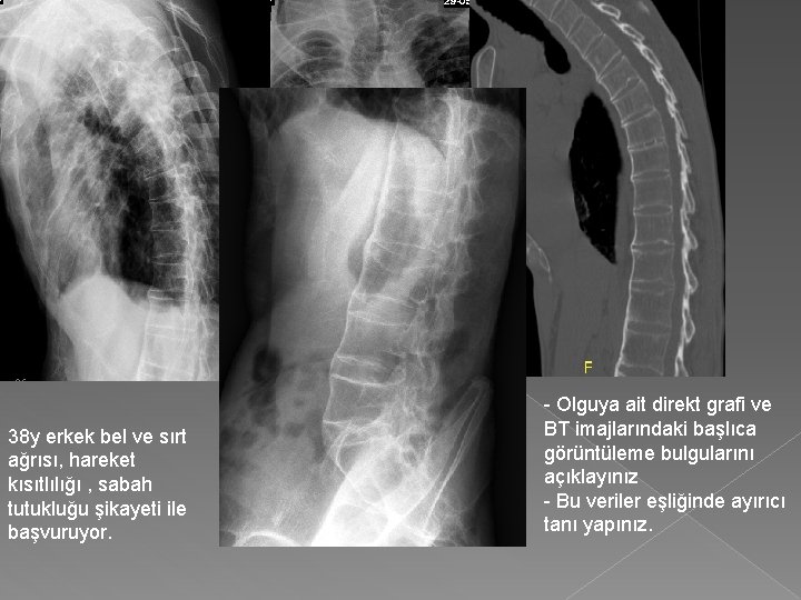 38 y erkek bel ve sırt ağrısı, hareket kısıtlılığı , sabah tutukluğu şikayeti ile