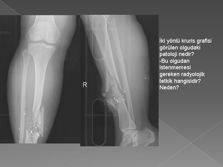 İki yönlü kruris grafisi görülen olgudaki patoloji nedir? -Bu olgudan istenmemesi gereken radyolojik tetkik