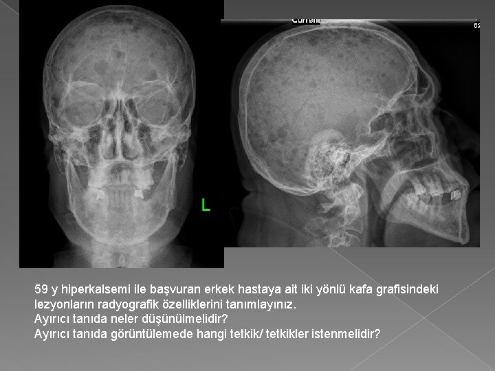 59 y hiperkalsemi ile başvuran erkek hastaya ait iki yönlü kafa grafisindeki lezyonların radyografik