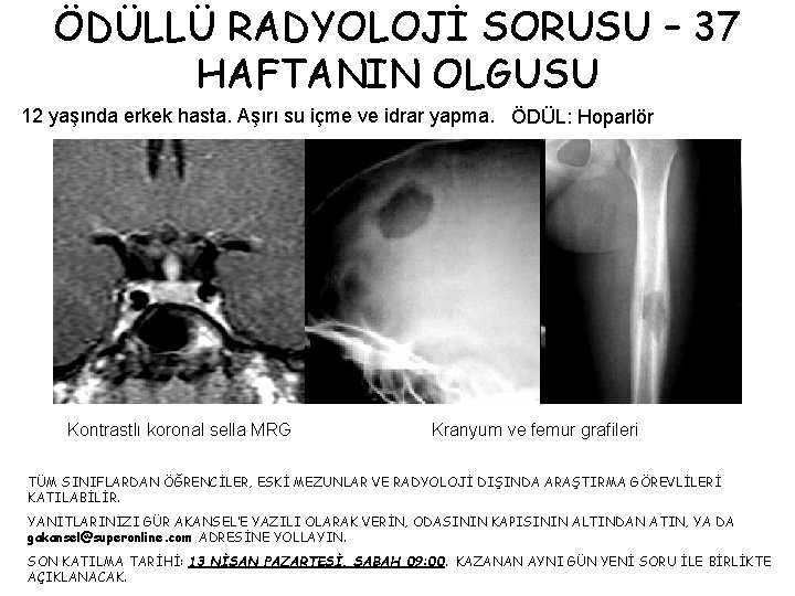 ÖDÜLLÜ RADYOLOJİ SORUSU – 37 HAFTANIN OLGUSU 12 yaşında erkek hasta. Aşırı su içme
