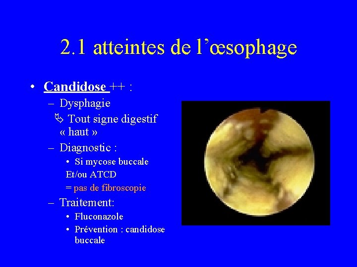 2. 1 atteintes de l’œsophage • Candidose ++ : – Dysphagie Tout signe digestif