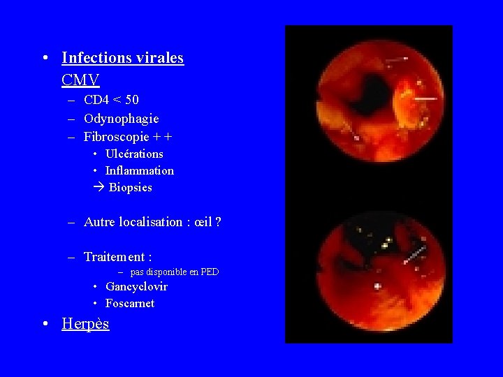  • Infections virales CMV – CD 4 < 50 – Odynophagie – Fibroscopie