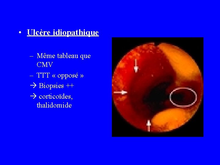  • Ulcère idiopathique – Même tableau que CMV – TTT « opposé »