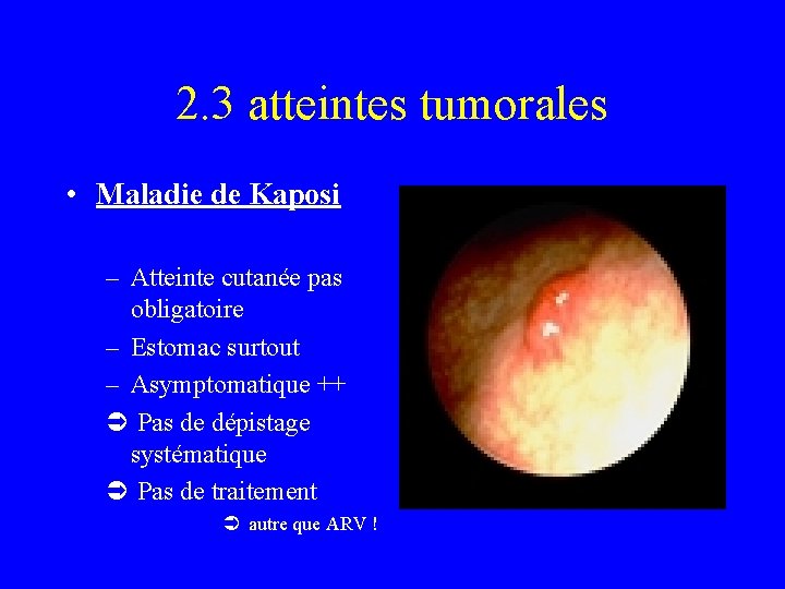2. 3 atteintes tumorales • Maladie de Kaposi – Atteinte cutanée pas obligatoire –