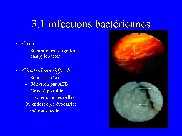 3. 1 infections bactériennes • Gram – – Salmonelles, shigelles, campylobacter • Clostridium difficile
