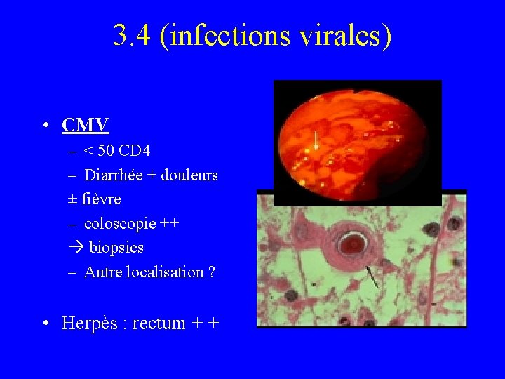 3. 4 (infections virales) • CMV – < 50 CD 4 – Diarrhée +