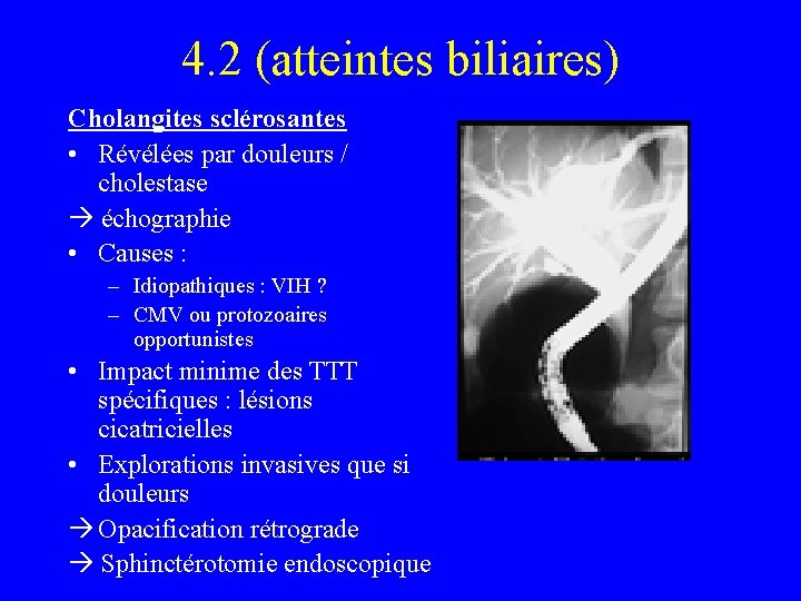 4. 2 (atteintes biliaires) Cholangites sclérosantes • Révélées par douleurs / cholestase échographie •