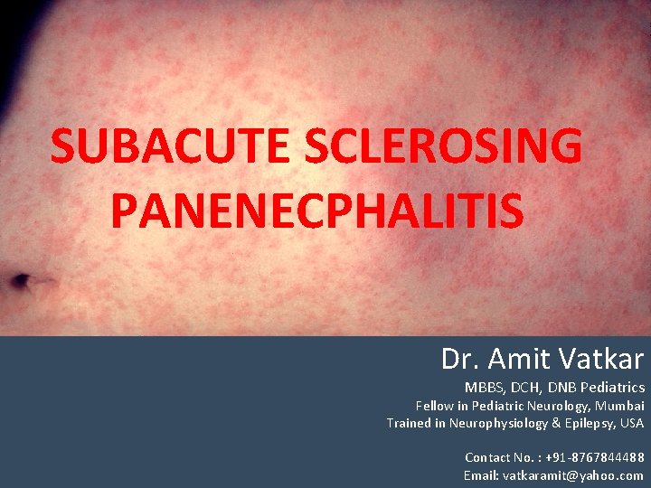 SUBACUTE SCLEROSING PANENECPHALITIS Dr. Amit Vatkar MBBS, DCH, DNB Pediatrics Fellow in Pediatric Neurology,