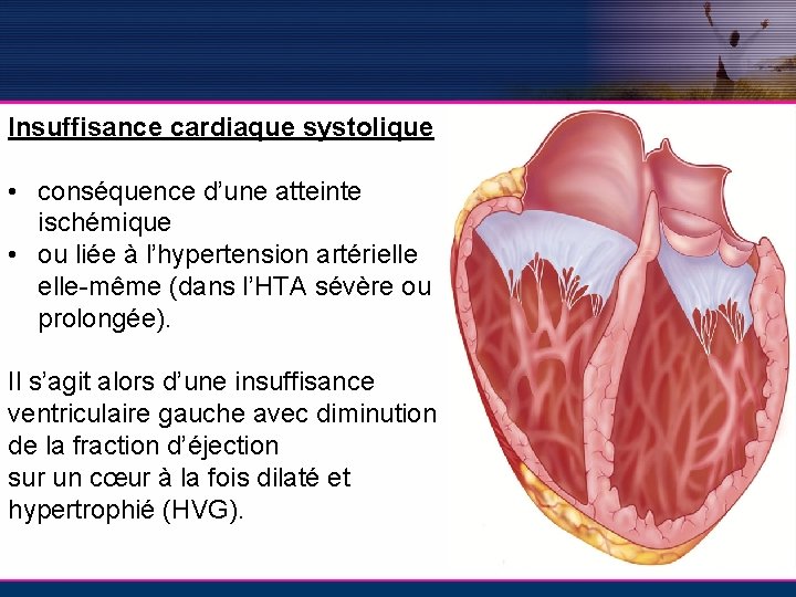 Insuffisance cardiaque systolique • conséquence d’une atteinte ischémique • ou liée à l’hypertension artérielle-même