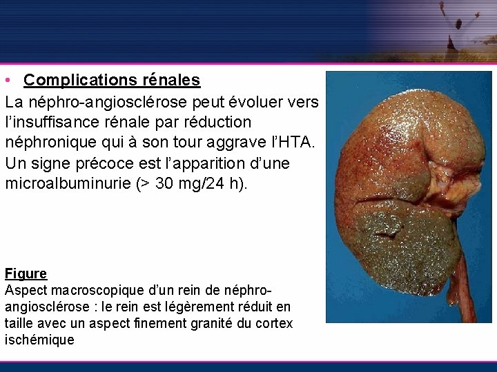  • Complications rénales La néphro-angiosclérose peut évoluer vers l’insuffisance rénale par réduction néphronique