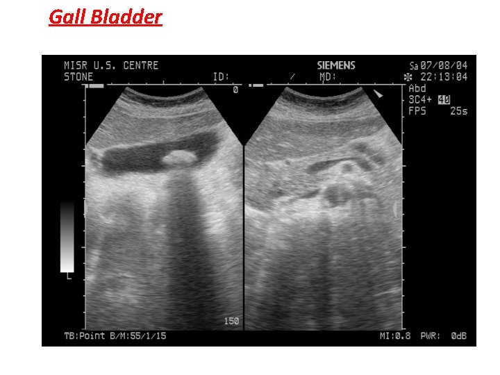 Gall Bladder 