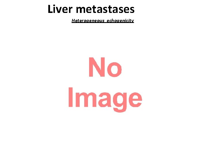 Liver metastases Heterogeneous echogenicity 