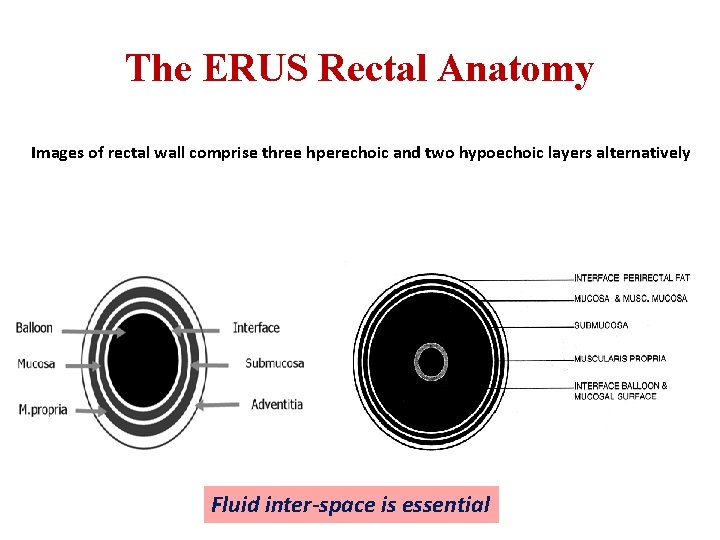 The ERUS Rectal Anatomy Images of rectal wall comprise three hperechoic and two hypoechoic