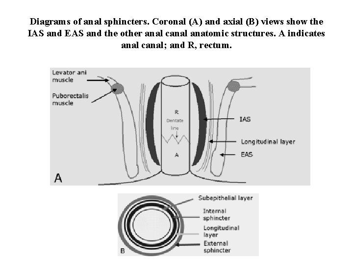Diagrams of anal sphincters. Coronal (A) and axial (B) views show the IAS and