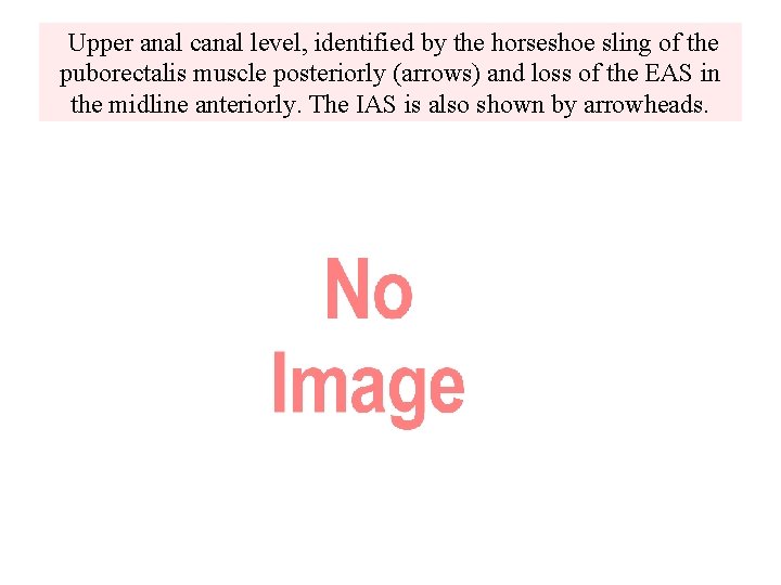  Upper anal canal level, identified by the horseshoe sling of the puborectalis muscle