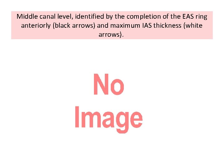 Middle canal level, identified by the completion of the EAS ring anteriorly (black arrows)