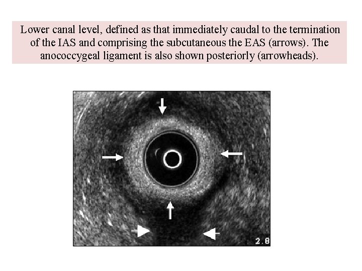  Lower canal level, defined as that immediately caudal to the termination of the
