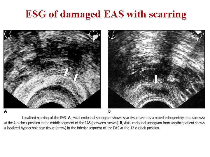 ESG of damaged EAS with scarring 