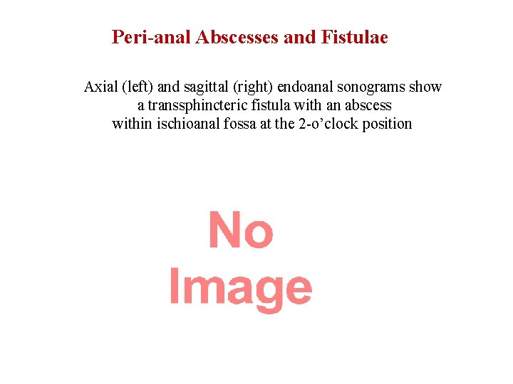 Peri-anal Abscesses and Fistulae Axial (left) and sagittal (right) endoanal sonograms show a transsphincteric