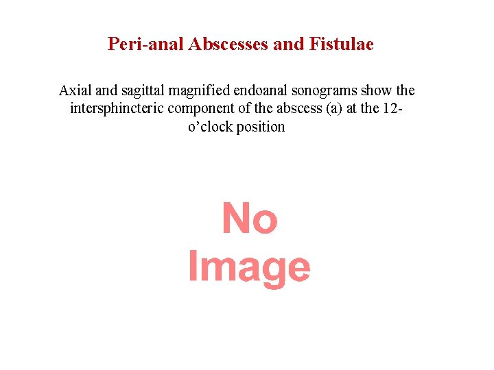 Peri-anal Abscesses and Fistulae Axial and sagittal magnified endoanal sonograms show the intersphincteric component
