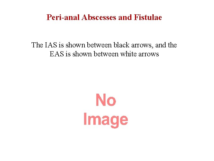 Peri-anal Abscesses and Fistulae The IAS is shown between black arrows, and the EAS