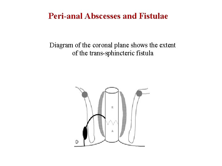 Peri-anal Abscesses and Fistulae Diagram of the coronal plane shows the extent of the