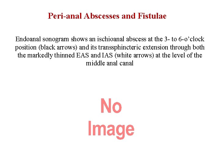 Peri-anal Abscesses and Fistulae Endoanal sonogram shows an ischioanal abscess at the 3 -
