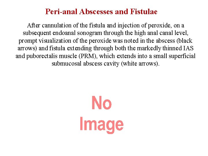 Peri-anal Abscesses and Fistulae After cannulation of the fistula and injection of peroxide, on