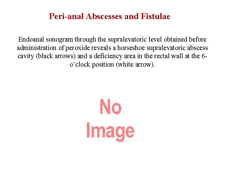 Peri-anal Abscesses and Fistulae Endoanal sonogram through the supralevatoric level obtained before administration of