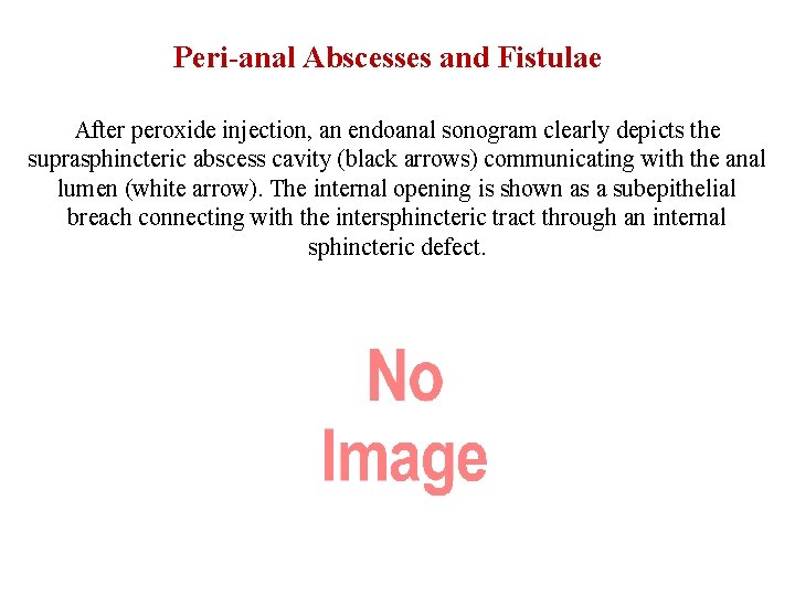 Peri-anal Abscesses and Fistulae After peroxide injection, an endoanal sonogram clearly depicts the suprasphincteric