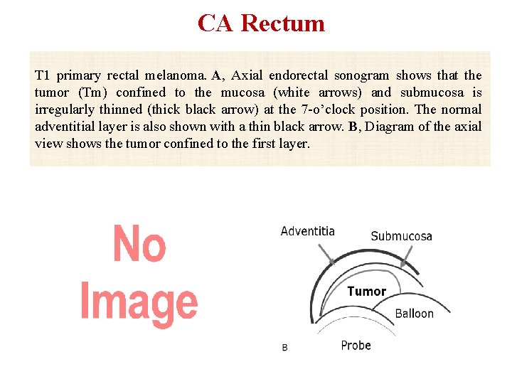 CA Rectum T 1 primary rectal melanoma. A, Axial endorectal sonogram shows that the