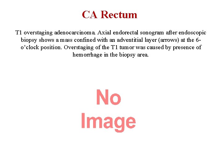 CA Rectum T 1 overstaging adenocarcinoma. Axial endorectal sonogram after endoscopic biopsy shows a