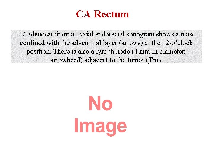 CA Rectum T 2 adenocarcinoma. Axial endorectal sonogram shows a mass confined with the