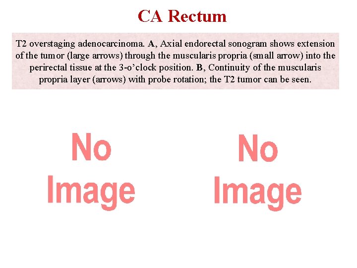 CA Rectum T 2 overstaging adenocarcinoma. A, Axial endorectal sonogram shows extension of the
