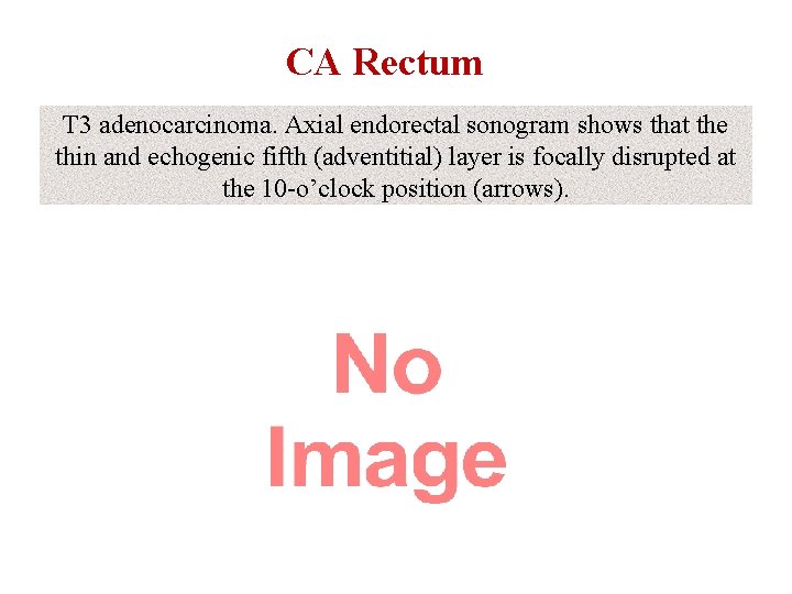 CA Rectum T 3 adenocarcinoma. Axial endorectal sonogram shows that the thin and echogenic